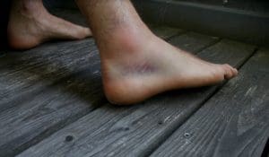 physical therapy can help ankle and foot pain.